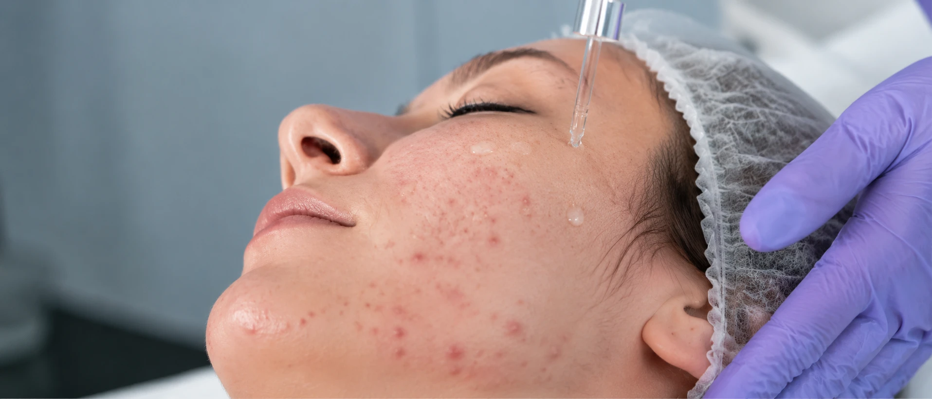 химический пилинг при акне